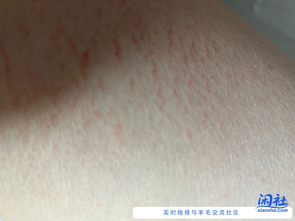 吧友们，大腿内侧这些是什么，一周了还没消下去